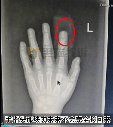 皇冠登3代理申请_小鹏汽车回应“X9屏幕夹断5岁男童半节食指”