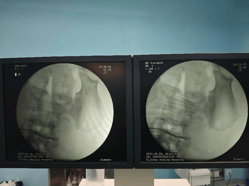 拜仁慕尼黑足球_整整37颗拜仁慕尼黑足球！云南4岁孩子身体里取出……医生紧急提醒！