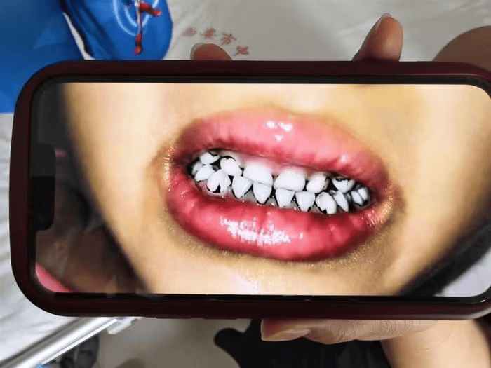 皇冠信用网开户_家长接到劝返电话“回甘肃去治”皇冠信用网开户，幼儿血铅中毒事件更多细节曝光