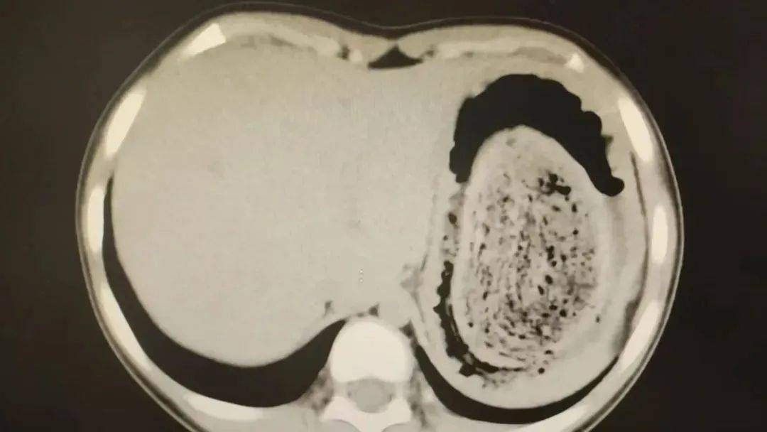 苏格兰超级联赛_发现1例苏格兰超级联赛，15岁女孩确诊！