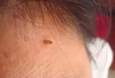 皇冠信用盘网址_脖子上长出的小肉粒皇冠信用盘网址，能揪吗？