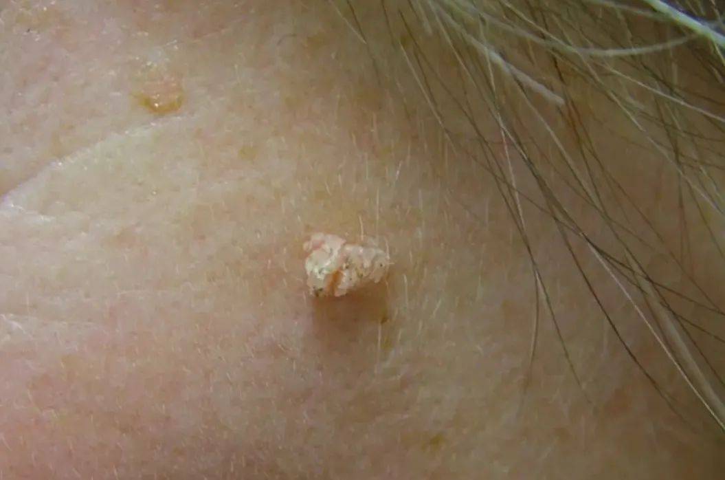 皇冠信用盘网址_脖子上长出的小肉粒皇冠信用盘网址，能揪吗？