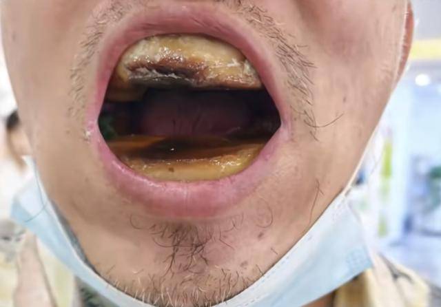 皇冠信用网出租代理_网购5元树脂补牙口腔如长出“烤年糕”皇冠信用网出租代理，老人求医无果引同情