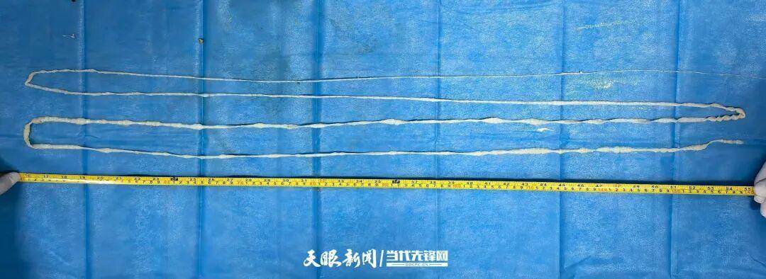 土耳其甲组联赛_最长4米！贵州一男子连续7个月排出“面条状异物”土耳其甲组联赛，医生：很可能和吃这种生食有关