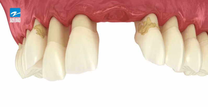 皇冠体育App下载_44岁女子牙齿掉光皇冠体育App下载！只因这个很多人都忽视的“小问题”……