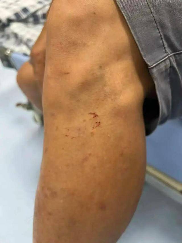 皇冠信用網需要押金吗_广东62岁阿叔网鱼网到2条眼镜蛇皇冠信用網需要押金吗，被咬伤后当场打死，并打包提进医院