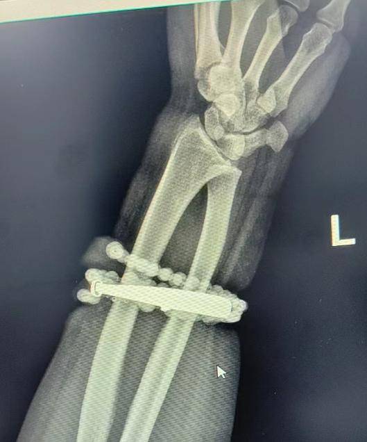 登1信用盘代理_女子手镯10年没摘竟“长”进肉里登1信用盘代理！医生：再晚点就保不住了