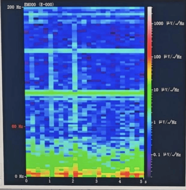 hga025怎么登录_山西首例hga025怎么登录！山西省人民医院成功实施脑机接口辅助功能区脑肿瘤切除手术